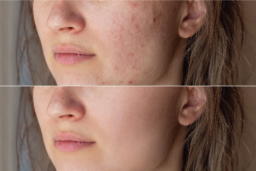 Acne issue