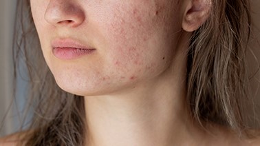 Prevent acne