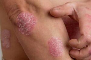 Eczema