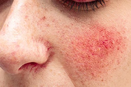 Rosacea Rosacea