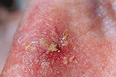 Skin Cancer Skin Cancer