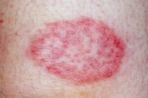 Skin Diseases