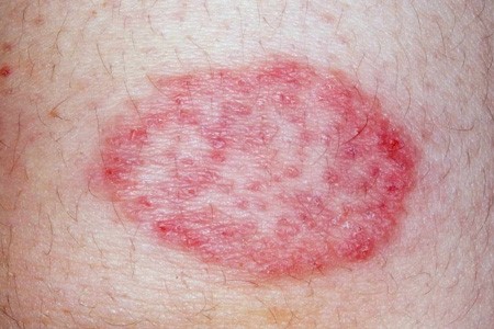 Skin Diseases Skin Diseases