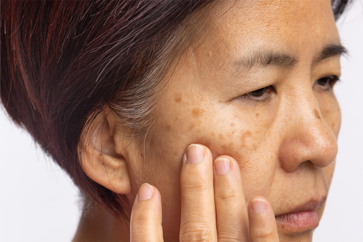 Reduce pigmentation