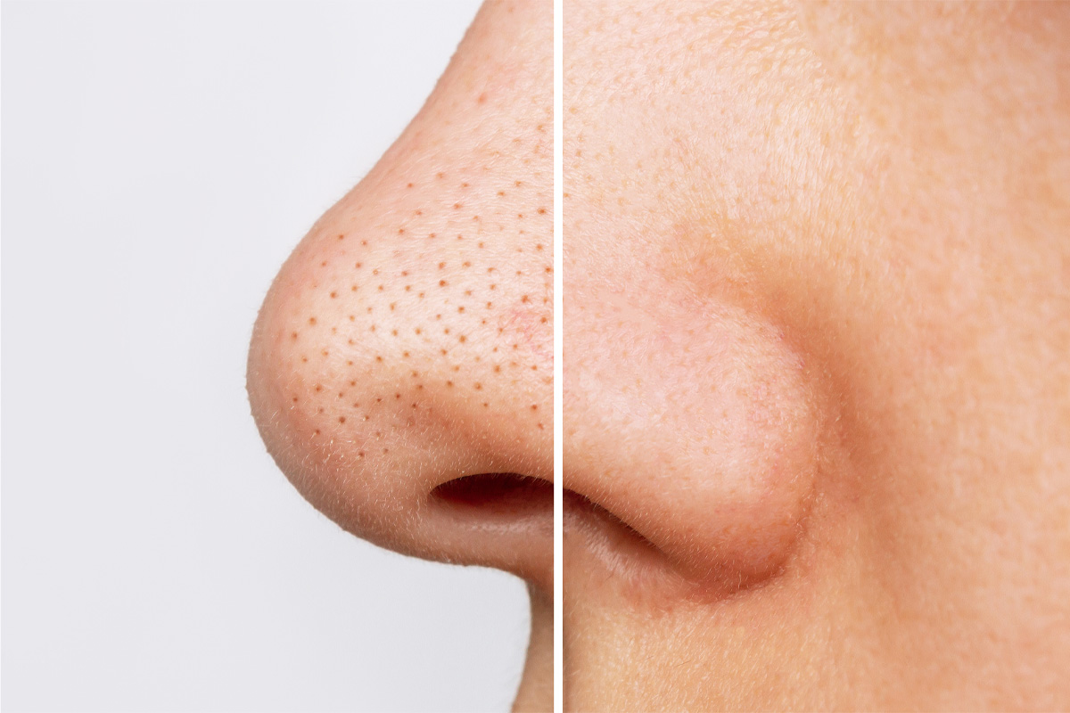 large pores